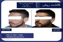 کلینیک زیبایی کاشت مو آفتاب در اصفهان، کاشت مو با بهترین متد آمریکا در اصفهان، تخصصی ترین مرکز کاشت مو در  اصفهان