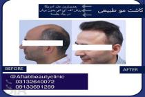 کلینیک زیبایی کاشت مو آفتاب در اصفهان، کاشت مو با بهترین متد آمریکا در اصفهان، تخصصی ترین مرکز کاشت مو در  اصفهان