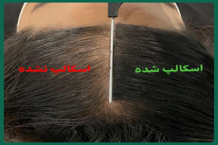 میکرو اسکالپ آزاده گلشنی، متخصص میکرو اسکالپ در لنگرود، بهترین مرکز کاشت مو در لنگرود، میکرو اسکالپ 09021607199 در رشت، مرکز تخصصی کراتین و بوتاکس مو در رشت