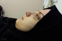 رینوپلاستی ،جراحی بینی وزیبایی در مشهد