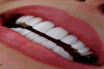 مهر نیکان بهترین کلینیک دندانپزشکی در کرج، کامپوزیت لیفت و لمینت روکش دندان و ونیر کامپوزیت و لیفت لثه تخصصی بصورت نقد و اقساط در کرج