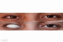 مرکز تخصصی ارتوپدی فنی و پروتز چشم دکتر فرهادی توماج، بهترین مرکز ارتوپدی فنی و پروتز چشم در گنبدکاووس، تولید ارتوز های مخصوص کودکان در گنبدکاووس، ساخت انواع پروتز چشم مصنوعی در گنبدکاووس