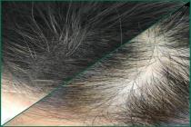 میکرو اسکالپ آزاده گلشنی، متخصص میکرو اسکالپ در لنگرود، بهترین مرکز کاشت مو در لنگرود، میکرو اسکالپ 09021607199 در رشت، مرکز تخصصی کراتین و بوتاکس مو در رشت