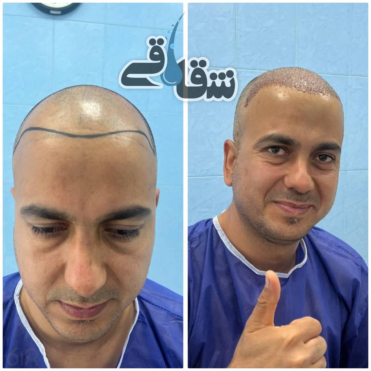 مجموعه کاشت مو شقاقی در مشهد، بهترین مجموعه کاشت مو در احمدآباد مشهد، کاشت مو تخصصی مشهد، مجموعه کاشت مو با مجوز رسمی در مشهد، خدمات کاشت مو با قیمت مناسب در احمدآباد مشهد